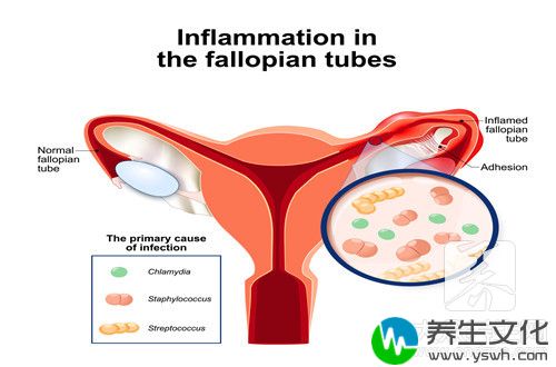  盆腔积液33mm正常吗