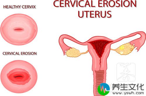  宫颈癌前病变是什么意思