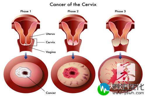 宫颈癌三期