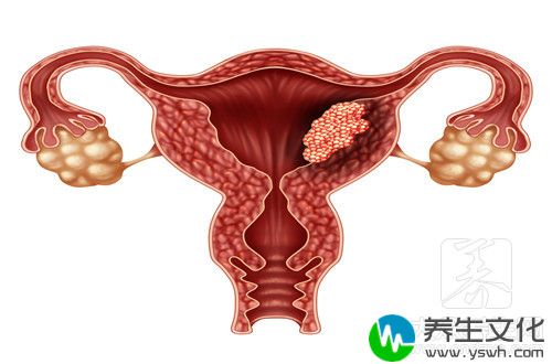 多发性子宫肌瘤一定要切除子宫吗