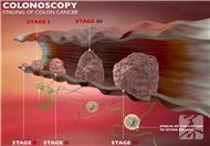 大肠癌的早期症状女性