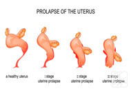 子宫下垂同房后果