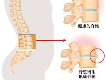 骨质增生的晚期症状有哪些