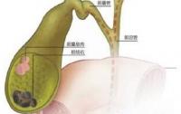 引起胆囊癌的原因有哪些 胆囊癌怎么治疗好