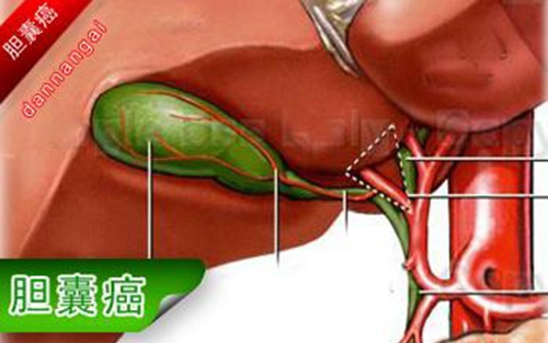 你是胆囊癌的高危人群么？看了这个远离胆囊癌