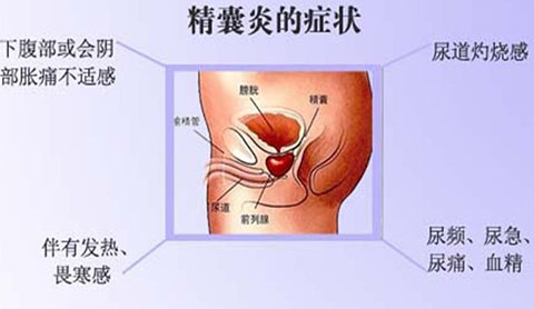 精囊炎的症状有哪些常见表现 对男性有什么危害