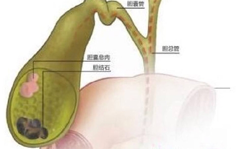 引起胆囊癌的原因有哪些 胆囊癌怎么治疗好