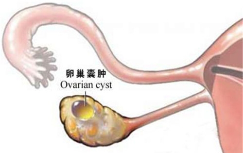 生理性卵巢囊肿有哪些症状？囊肿不治疗会自己消失吗？